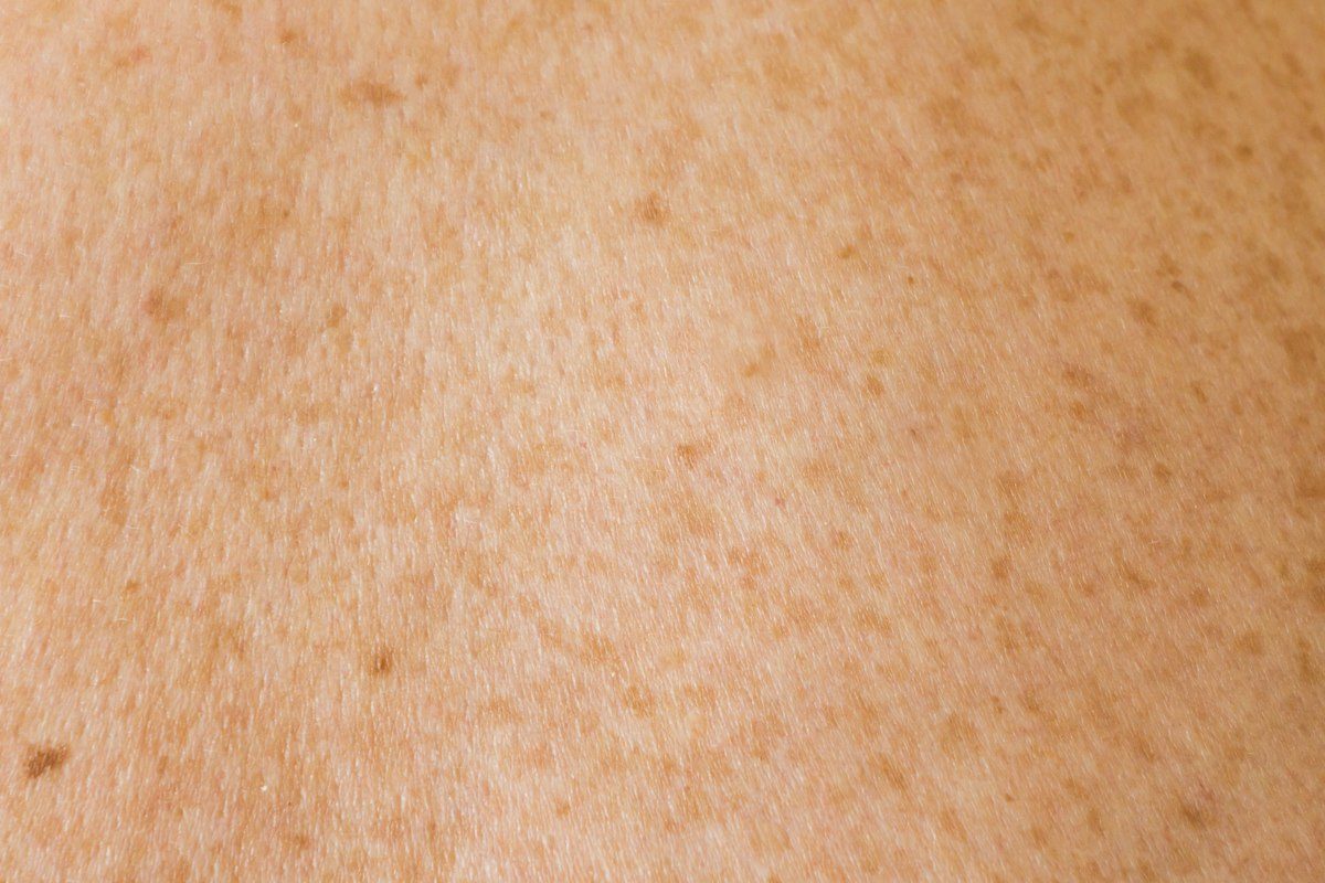 A close up of a person's back with brown spots